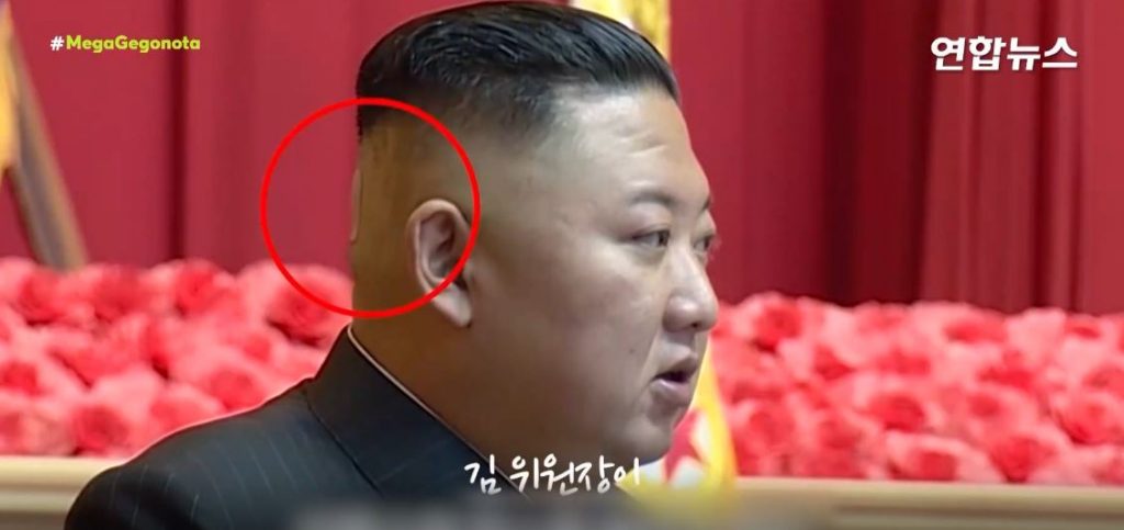 Βόρεια Κορέα – Νέα σενάρια για την υγεία του Κιμ Γιονγκ Ουν μετά την εμφάνιση με μεγάλο τσιρότο στο κεφάλι του