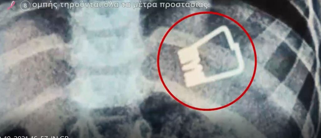 Λήμνος – Αγοράκι δύο ετών κατάπιε έλασμα από μανταλάκι