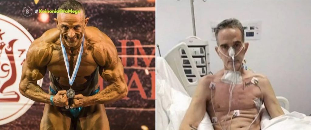 Κορωνοϊός – Συγκλονιστική μαρτυρία – «Έχασα 42 κιλά μετά από δύο μήνες στη ΜΕΘ – Ακόμα δυσκολεύομαι να περπατήσω»