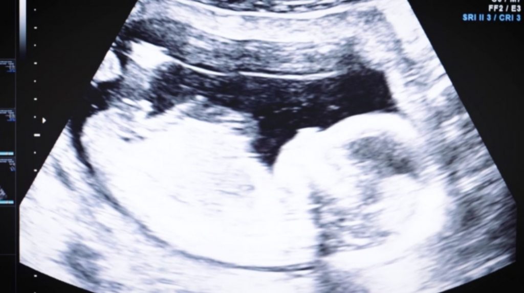 Κορωνοϊός – Στο στόχαστρο του ιού οι έγκυες – Σοβαρός ο κίνδυνος νόσησης