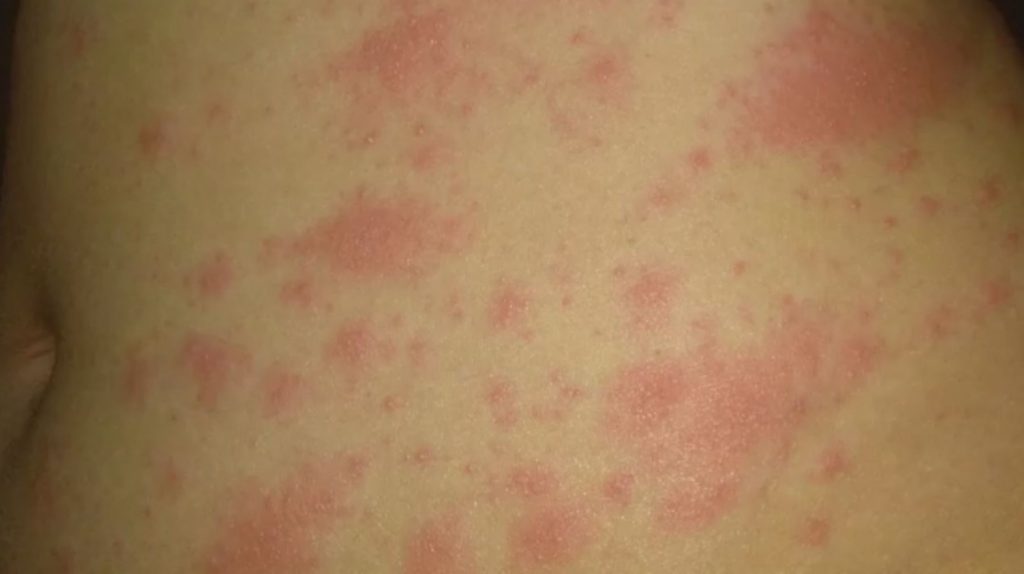 Αυτά είναι τα δερματικά συμπτώματα της Όμικρον