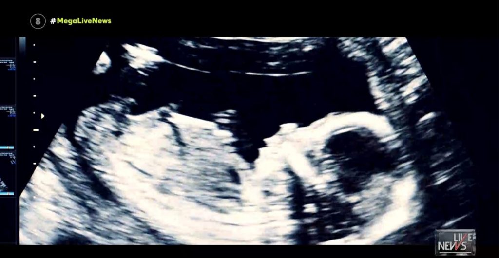 Κορωνοϊός – «Θερίζει» έμβρυα & εγκύους ο κορωνοϊός – Καμπανάκι κρούουν οι γυναικολόγοι