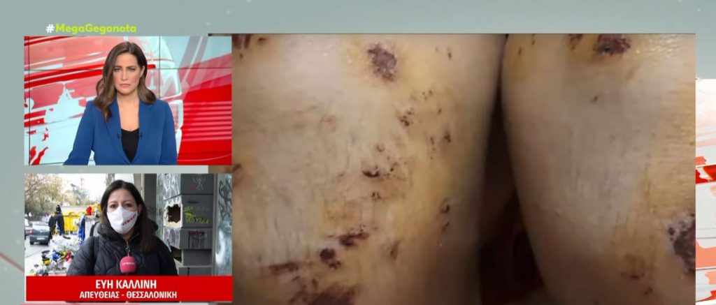 Νέα οπαδική επίθεση-σοκ στη Θεσσαλονίκη: Χτύπησαν με μανία 14χρονο στην παραλία