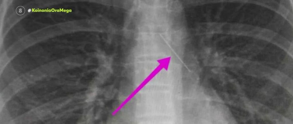 Θεσσαλονίκη: Ανήλικη κατάπιε καρφίτσα – Μάχη των γιατρών για να την βγάλουν από τα πνευμόνια της