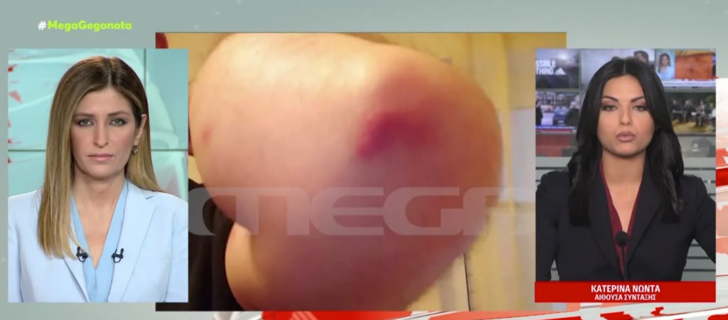 Καταγγελίες σοκ: Οδηγοί φορτηγών με σημάδια στο σώμα από τσιμπήματα κοριών και ψύλλων