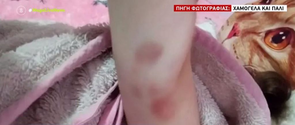 Πάτρα: Όλη η αλήθεια για τις μελανιές της Τζωρτζίνας