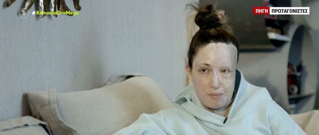 Ιωάννα Παλιοσπύρου: Έδειξε το πρόσωπό της & περιέγραψε τις δραματικές στιγμές της επίθεσης με βιτριόλι