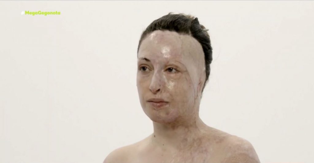 Η Ιωάννα Παλιοσπύρου έβγαλε τη μάσκα και έδειξε το πρόσωπό της μετά την επίθεση με βιτριόλι