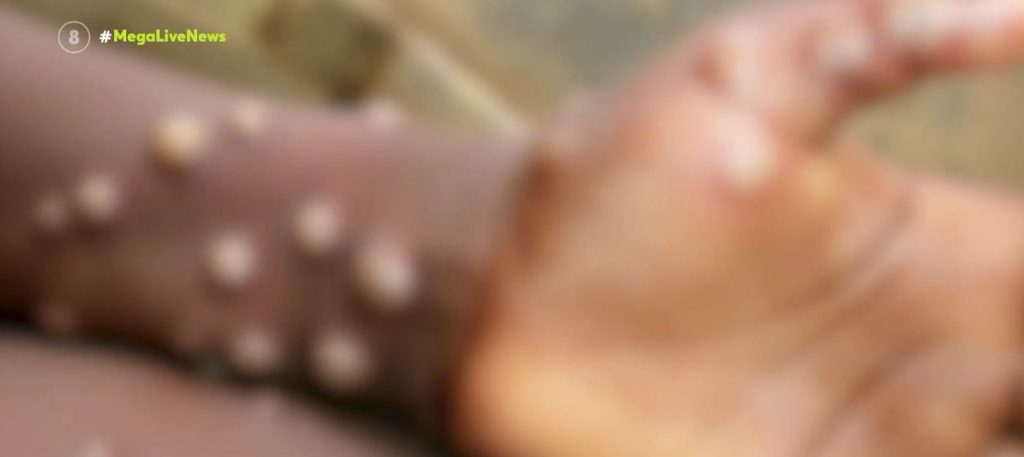 Ευλογιά των πιθήκων: Συναγερμός στις υγειονομικές Αρχές – Φόβοι για τη ραγδαία διασπορά της