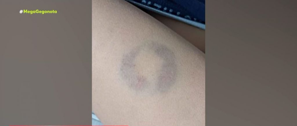 Άρτα: Διευθύντρια σχολείου δάγκωσε μαθητή ΑμεΑ