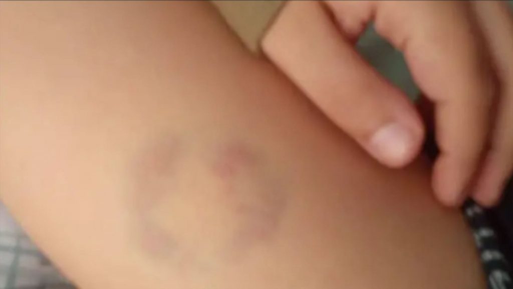 Δασκάλα δάγκωσε παιδί με αυτισμό γιατί της τραβούσε τα μαλλιά