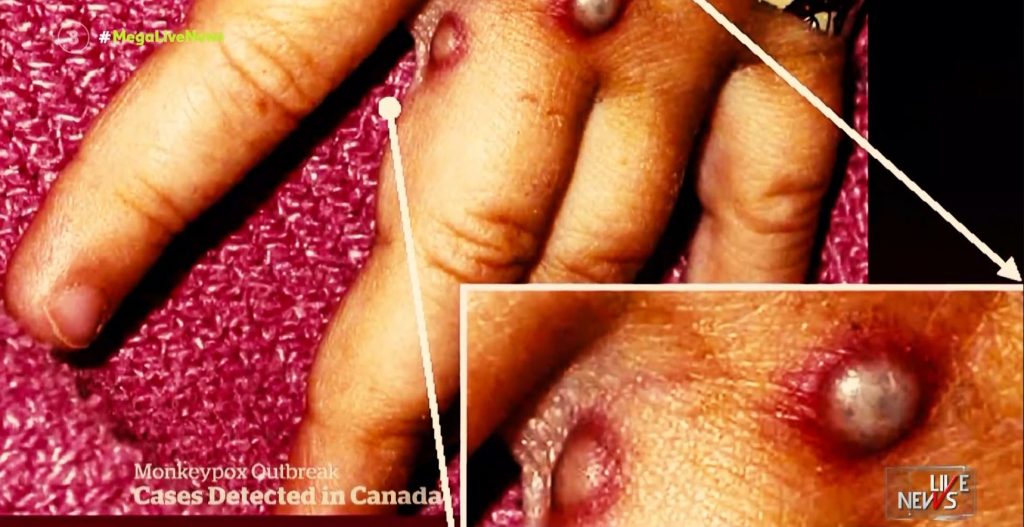 Ευλογιά των πιθήκων: Εντοπίστηκε το πρώτο κρούσμα στην Ελλάδα