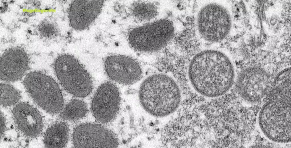 Ευλογιά των πιθήκων: Πρώτο επιβεβαιωμένο κρούσμα στην Ελλάδα