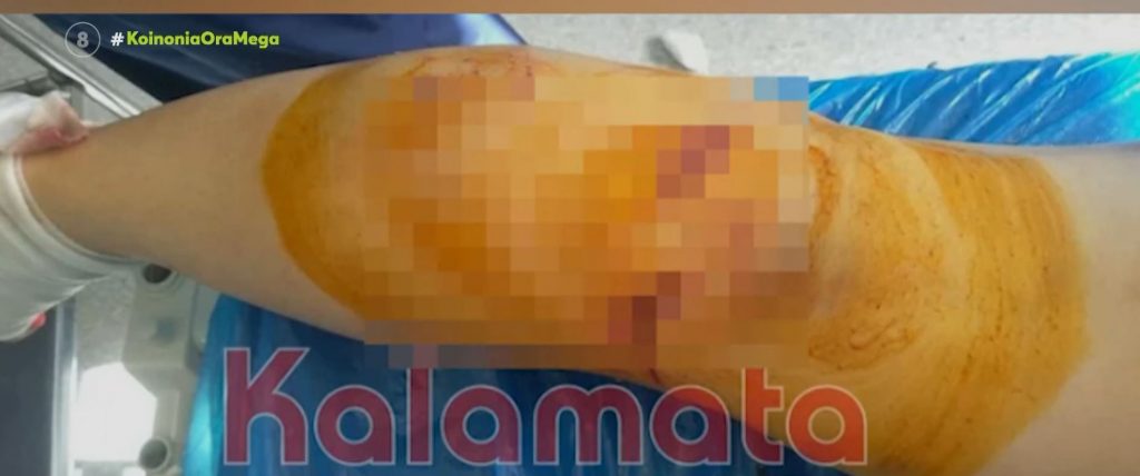 Καλαμάτα: Αγέλη σκύλων κατασπάραξαν 34χρονη
