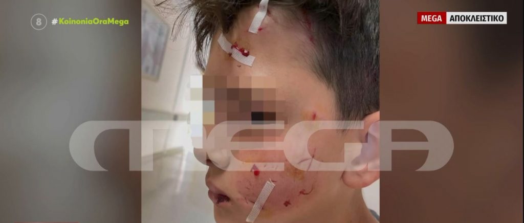 Λαγονήσι: Σκύλος κατασπάραξε αγοράκι την ώρα που πήγαινε στο σχολείο – Τι είπε η μητέρα του μαθητή στο MEGA