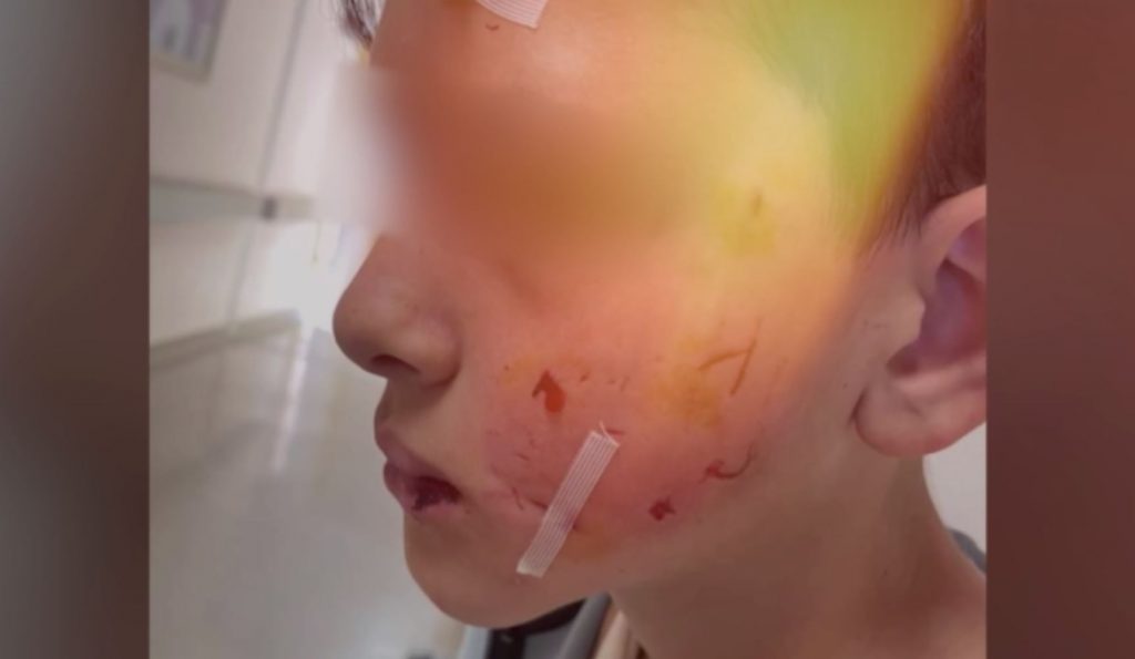 Λαγονήσι: Σκύλος επιτέθηκε σε μαθητή την ώρα που πήγαινε σχολείο – Η μητέρα του παιδιού μίλησε στο MEGA