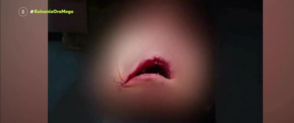 Λουτράκι: Ανήλικοι ξυλοκόπησαν συμμαθητή τους και τον έστειλαν στο νοσοκομείο