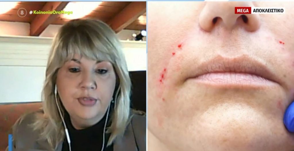 Απίστευτη καταγγελία: Έκαναν botox ακόμα και σε “νυχάδικα” – Αγνώριστα τα θύματα