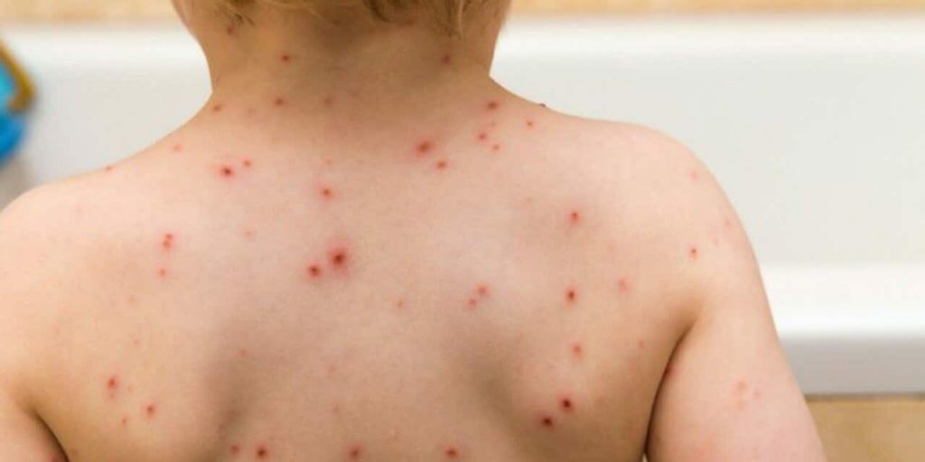 «Θερίζει» η ιλαρά – Ανησυχία σε γονείς και ειδικούς για τα κρούσματα