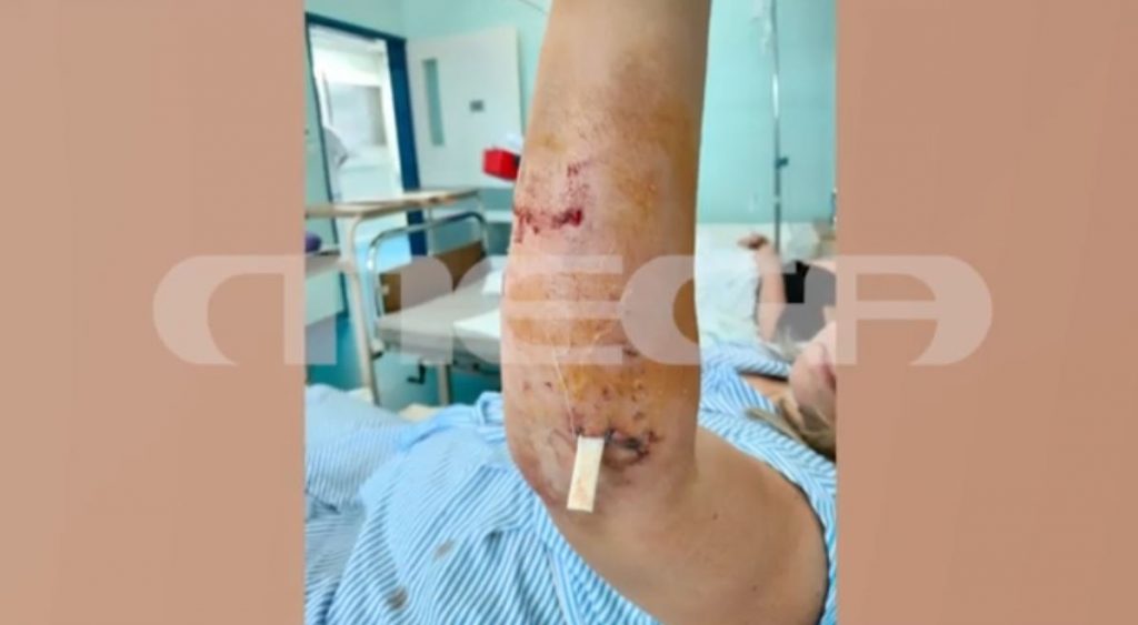 Χαλκιδική: Η συγκλονιστική περιγραφή της 39χρονης που την δάγκωσε σκύλος