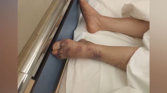 Αττική: Καταγγελία για κακοποίηση σε ιδιωτικό οίκο ευγηρίας – «Ήταν μαυρισμένα τα πόδια της & τα πλευρά της»