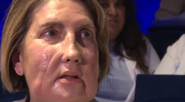 Ισπανία: Μεταμόσχευση προσώπου από δότρια που έκανε ευθανασία