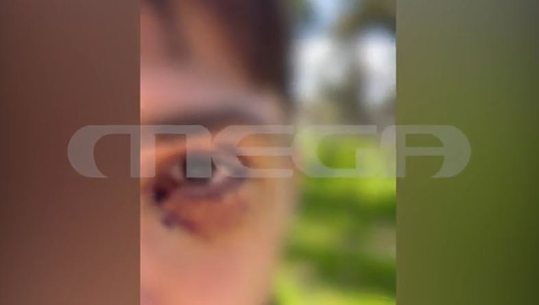 Ιωάννινα: Σοκάρει στο MEGA ο 16χρονος που δέχθηκε άγρια επίθεση από ομάδα ανηλίκων