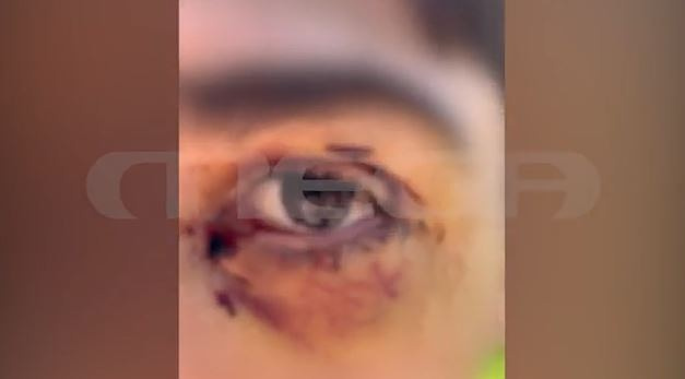 Ιωάννινα: 16χρονος δέχτηκε επίθεση από άλλους ανήλικους – Παρ’ ολίγον να χάσει το μάτι του