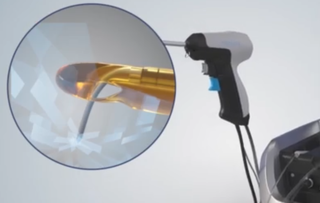 Σύγχρονη αντιμετώπιση της καλοήθους υπερπλασίας του προστάτη με τη μέθοδο RezUm